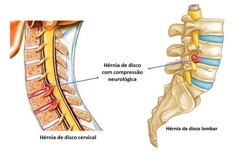 Tratamento da Hérnia de Disco Dr Ricardo Teixeira