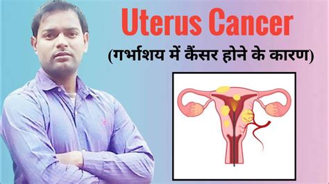 Uterus Cancer । महिलाओं के गर्भाशय बच्चेदानी में कैंसर होने के कारण । Youtube