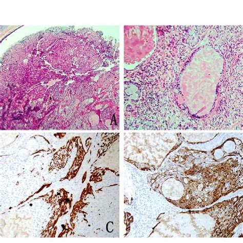 Pathology Image Of Low Grade Mucoepidermoid Carcinoma A The Nests Of Download Scientific