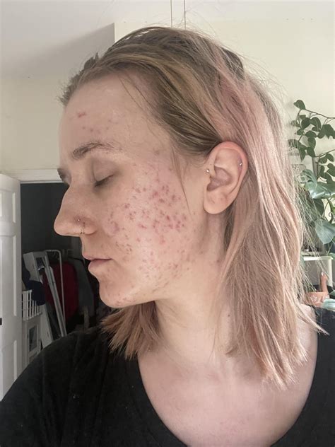 A long and painful journey, it gets better! : r/acne