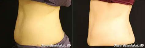 Coolsculpting Franklin Tn Franklin Skin And Laser Nashville