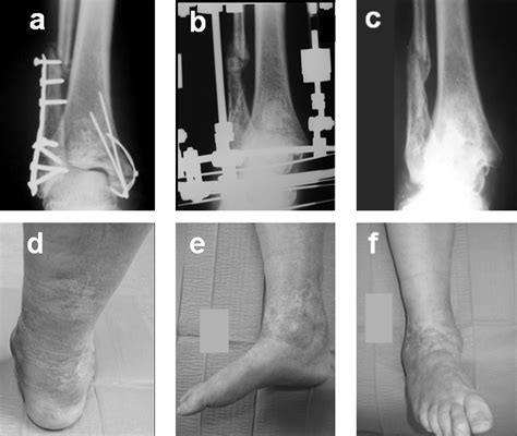 Ankle And Foot Osteomyelitis Treatment Protocol And Clinical Results Injury