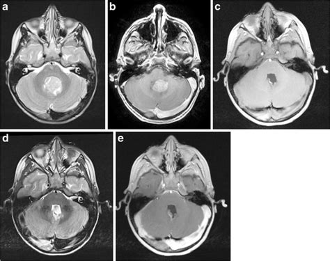 Intraoperative MRI In Pediatric Brain Tumors SpringerLink