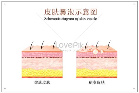 Schematic diagram of skin vesicles in skin lesions illustration image ...