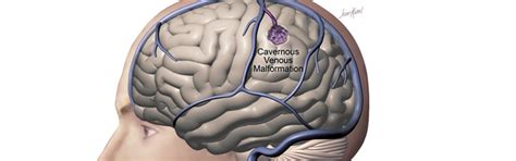 Cavernous Hemangioma Brain