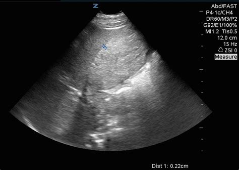 What’s causing his RUQ pain? | Hennepin Ultrasound