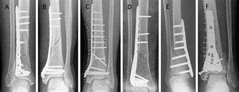 Complications And Functional Outcome After Fixation Of Distal Tibia