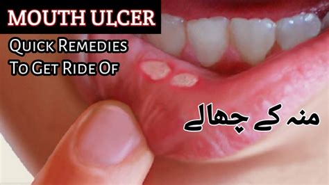 Mouth Ulcer Home Remedy Oral Ulcer Treatment Muh K Chalon Ka Ilaj