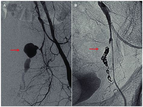 A Angiography Of The Left Common Iliac Artery Revealed A