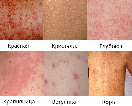 Потница у детей: фото, симптомы и лечение