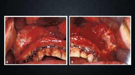 Lefort Fracture Ppt