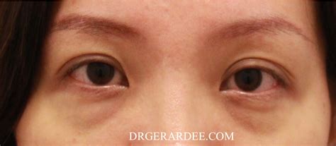 A Review Of Dark Eye Circle Treatments • Dr Gerard Ee