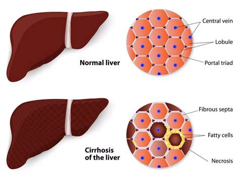 Liver Cirrhosis Ppt