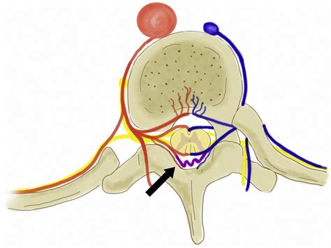 Spinal Dural Av Fistula Mri