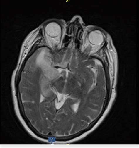 Magnetic resonance imaging (MRI) of the head MRI of the head shows an ...