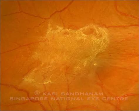 Epiretinal Membrane Peel Surgery