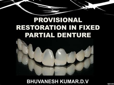 Provisional Restoration In Fixed Partial Denture Ppt Free Download