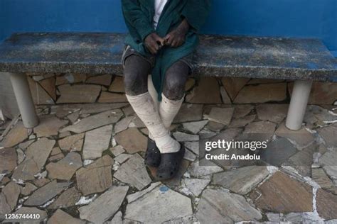 Leprosy Photos and Premium High Res Pictures - Getty Images