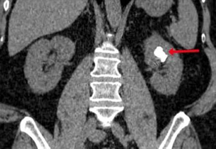 TRATAMENTO DA NEFROLITÍASE EM CURITIBA Dr Ruimário