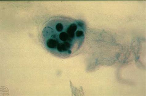 Entamoeba Histolytica