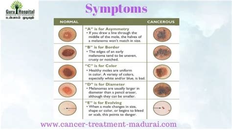 Skin Cancer Skin Cancer Treatment Kimaja Farwani