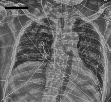 Intra Aortic Balloon Pump Image