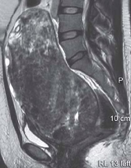 Mri Sagittal View Showing Large Fibroid Uterus Download Scientific Diagram