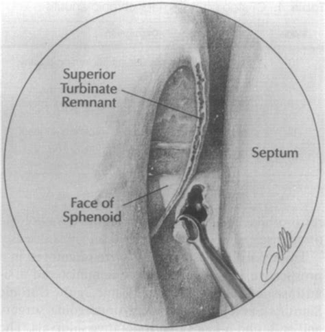 Endoscopic Treatment Of Sphenoid Sinusitis Ralph Metson Richard E