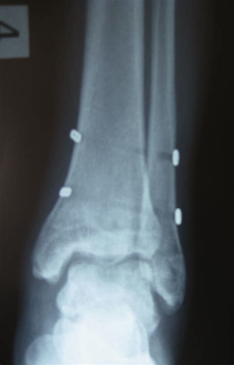 Tightrope Fixation Of Ankle Syndesmosis Injuries Clinical Outcome