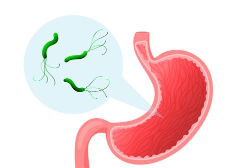 Helicobacter Pylori Una Bacteria Silenciosa