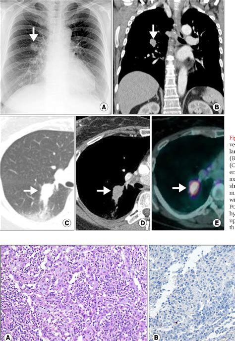 Figure 1 From A Case Of Primary Pulmonary Lymphoepithelioma Like