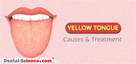 Yellow tongue: Causes and treatment - Dental Science