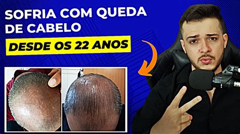 Calv Cie Masculina Resultado Em Menos De Dias Queda De Cabelo