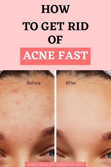 How To Get Rid Of Acne Fast In How To Get Rid Of Acne Clear