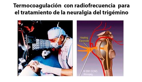 Neuralgia Del Trigémino