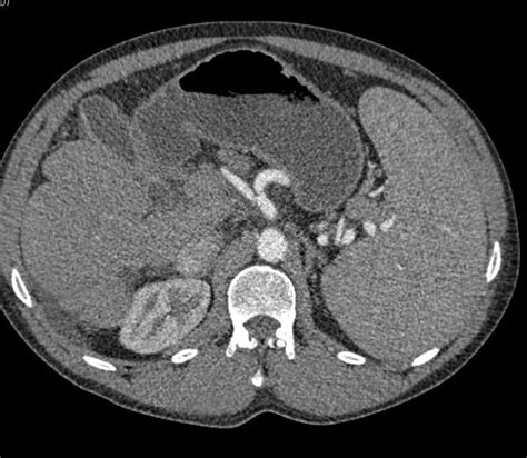 Cirrhosis With Portal Hypertension And Varices And Splenomegaly Liver