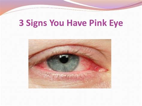 3 Signs You Have Pink Eye