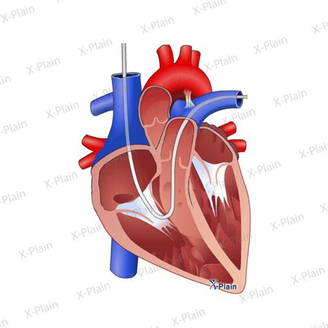 Right Heart Catheterization