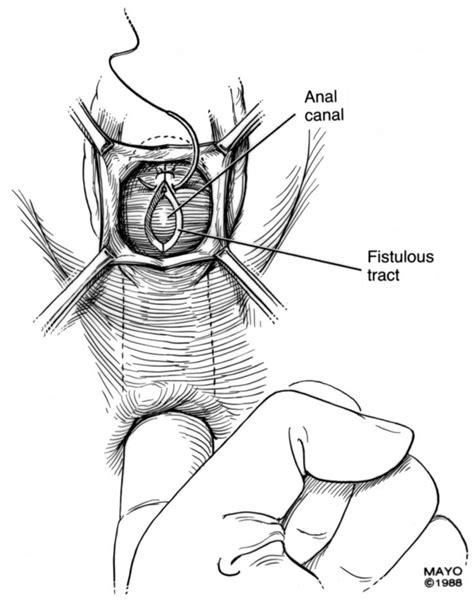 Colorectal Vaginal Fistulas Imaging And Novel Interventional Treatment