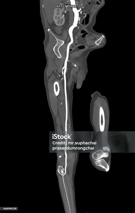 Cta Femoral Artery Run Off Mpr Curve Showing Right Femoral Artery For Diagnostic Acute Or