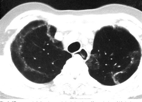 Figure 2 from Chronic eosinophilic pneumonia with subpleural ...