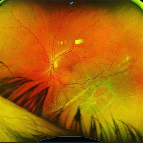 Rhegmatogenous Retinal Detachment Outlook Eye Specialists