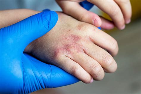 Ringworm In Children