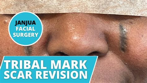 Tribal Mark Scar Revision Surgery Consultation Dr Tanveer Janjua