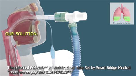 The Patented Popsafe™ Et Endotracheal Tube Set By Smart Bridge Medical