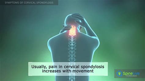 Cervical Spondylosis Symptoms