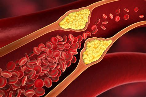 Aterosclerosis Y Sus Complicaciones