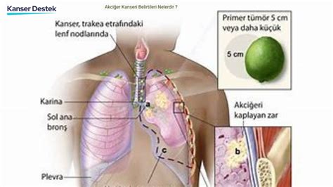 Akci Er Kanseri Evreleri Ve A Ya Am S Resi