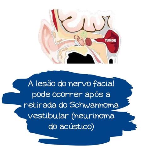 Nervo Facial após Neurinoma Do Acústico e Schwannoma Vestibular