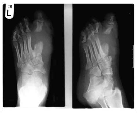 Postoperatively, preservation of the first metatarsal and... | Download Scientific Diagram